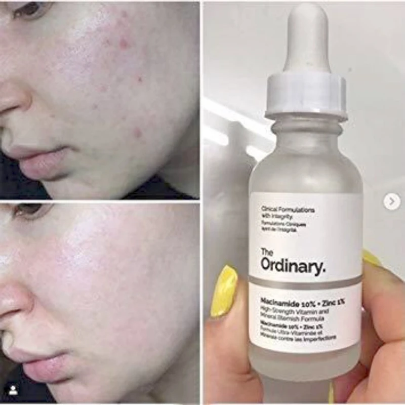 𝐓𝐡𝐞 𝐎𝐫𝐝𝐢𝐧𝐚𝐫𝐲 𝐍𝐢𝐚𝐜𝐢𝐧𝐚𝐦𝐢𝐝𝐞 𝟏𝟎% + 𝐙𝐢𝐧𝐜 𝟏%(30ml) - Image 7