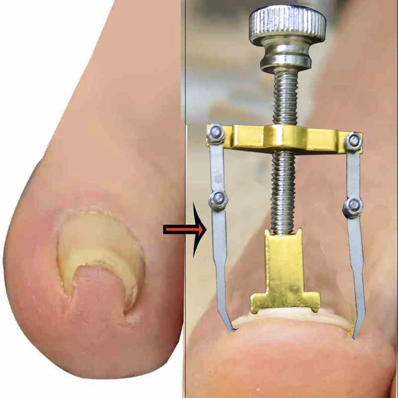 নখের কোনা সোজা করার অত্যাধুনিক যন্ত্র ( Nail Repair