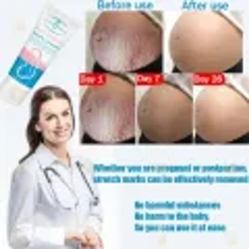 Anti Stretch Mark Cream scar cream Pregnancy Scar Removal Repair Cream Stretch Marks Whitening Fades Stretch Marks Repair Scar Slack Line Skin Care
