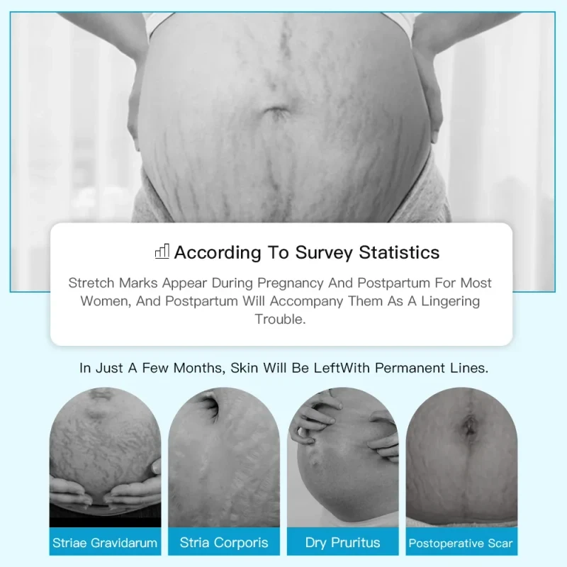 Anti Stretch Mark Cream scar cream Pregnancy Scar Removal Repair Cream Stretch Marks Whitening Fades Stretch Marks Repair Scar Slack Line Skin Care - Image 8