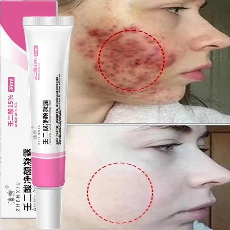 Azelaic Acid Cleansing Gel & Salicylic Acid Pore Refining Cream - Image 5