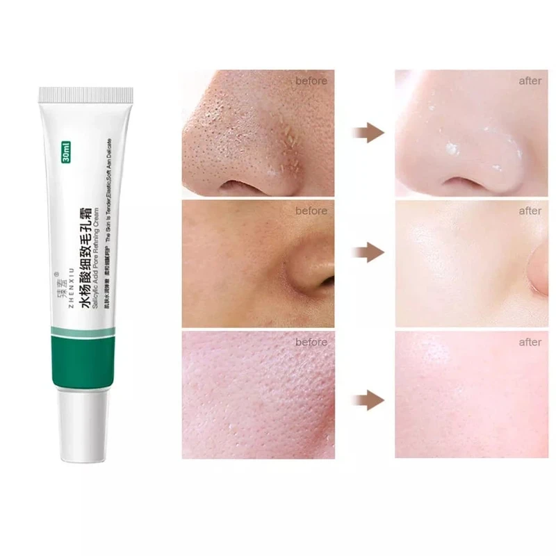 Azelaic Acid Cleansing Gel & Salicylic Acid Pore Refining Cream - Image 6