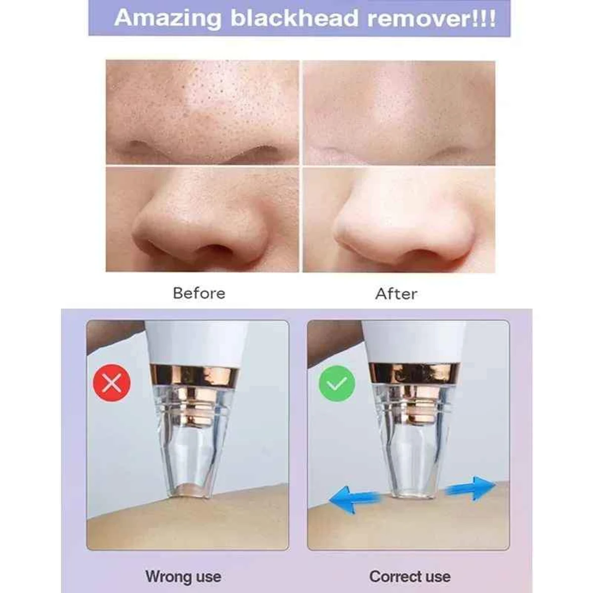 blackhead Remover - Thumbnail 3